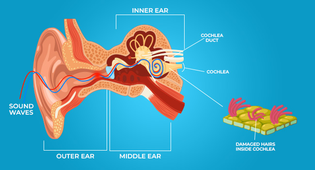 Noise-Induced Hearing Loss
